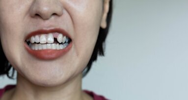Poor glycaemic control results in tooth loss in middle age, study finds