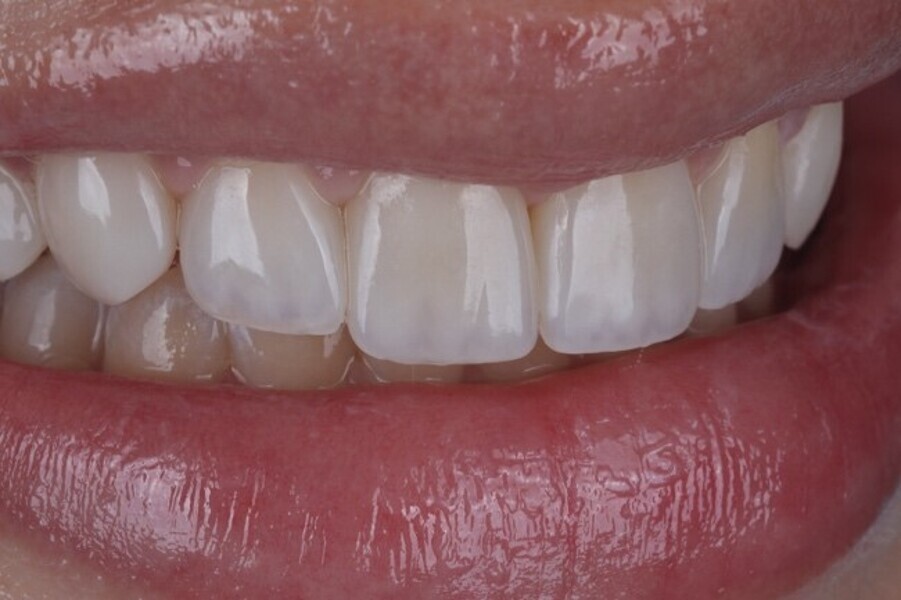 Fig. 3o: Side  profile view if the smile modification highlighting the natural life-like aesthetics achieved with the direct composite veneer restorations using the micd biological layering technique.