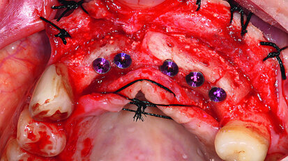 Implant retreatment