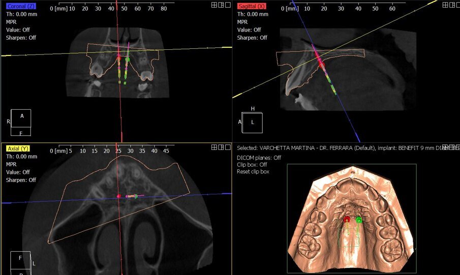 Fig. 4_Progettazione digitale mediante protocollo Easy Driver della posizione delle miniviti ortodontiche. Mediante il software è possibile programmare sito di inserimento, profondità è inclinazione dei TADs.