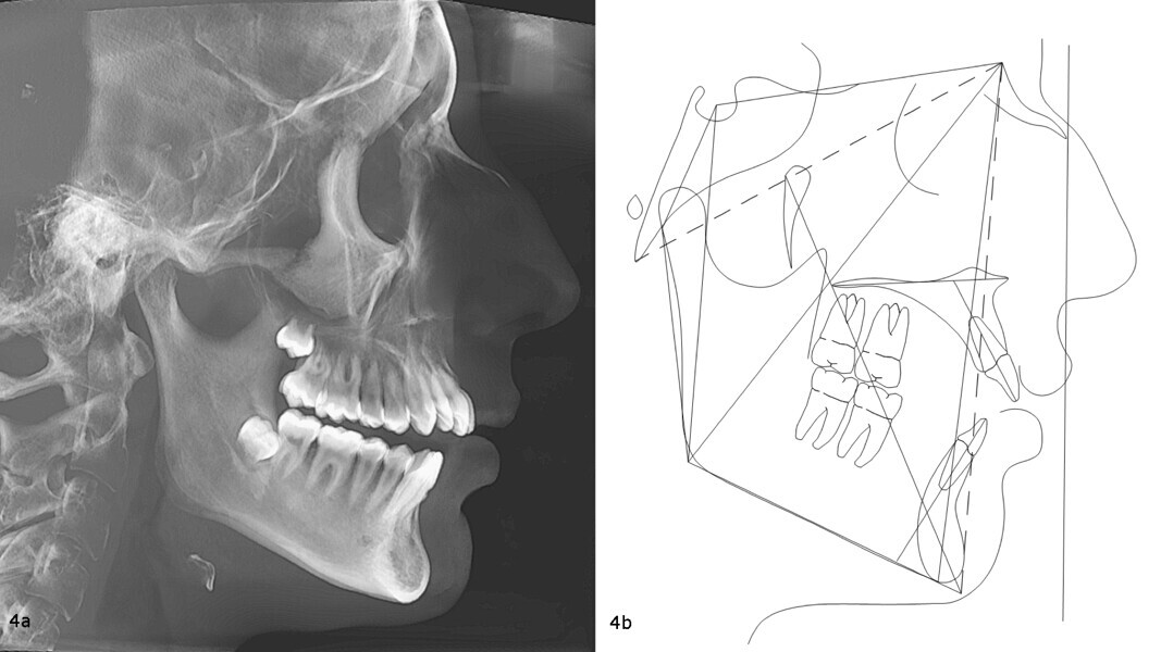 Figs. 4a & b: Pretreatment cephalometric radiograph (a) and tracing (b).