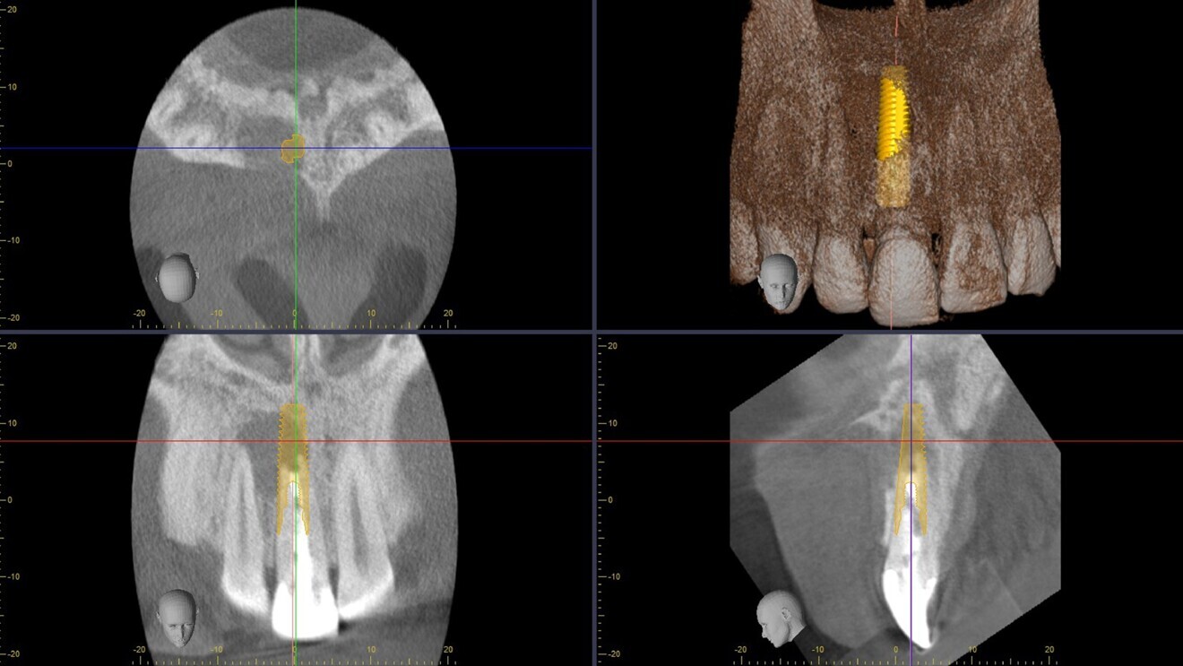 Fig. 4: CBCT scan showing the planned implant placement.