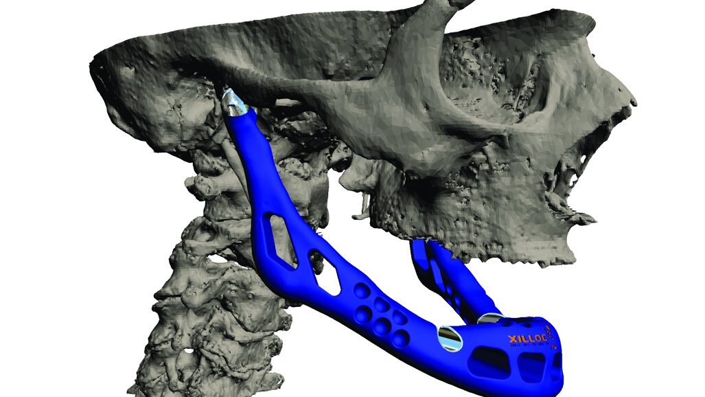 LayerWise construit le premier implant personnalisé de reconstruction mandibulaire totale