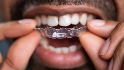 Periodontal considerations in aligner treatment
