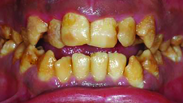 Cosmetic enamel restoration using naturomimetic layering technique—Part I