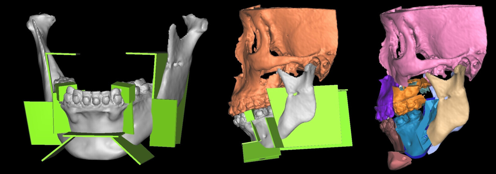 3D planning for the segmental mandibular advancement surgery. (Image: Mike Yiu-yan Leung)