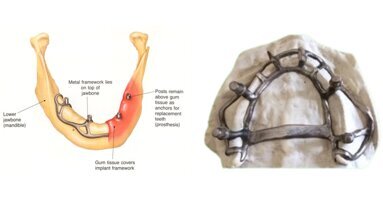 AMSJI bij de extreem geatrofieerde edentate maxilla
