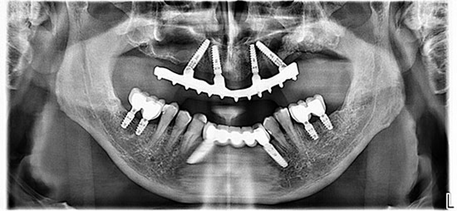 Fig. 27. OrtopantomografÃ­a de control al aÃ±o de la carga donde se aprecia la estabilidad del hueso periimplantario.