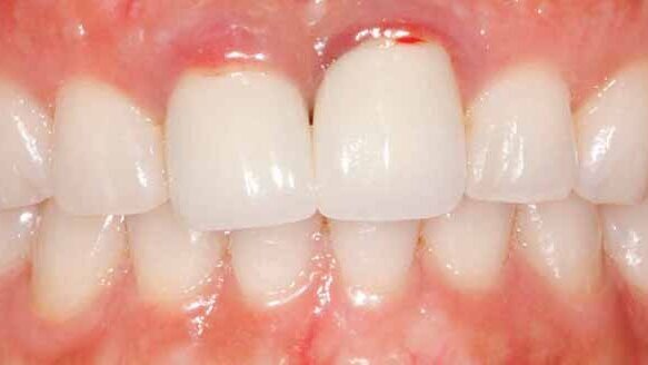 Solid zirconia restoration