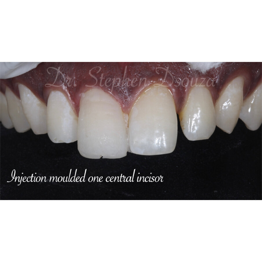 Fig. 7 Moulding completed on the right central incisor