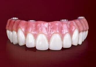 BruxZir® Solid Zirconia Full-Arch Implant Prosthesis