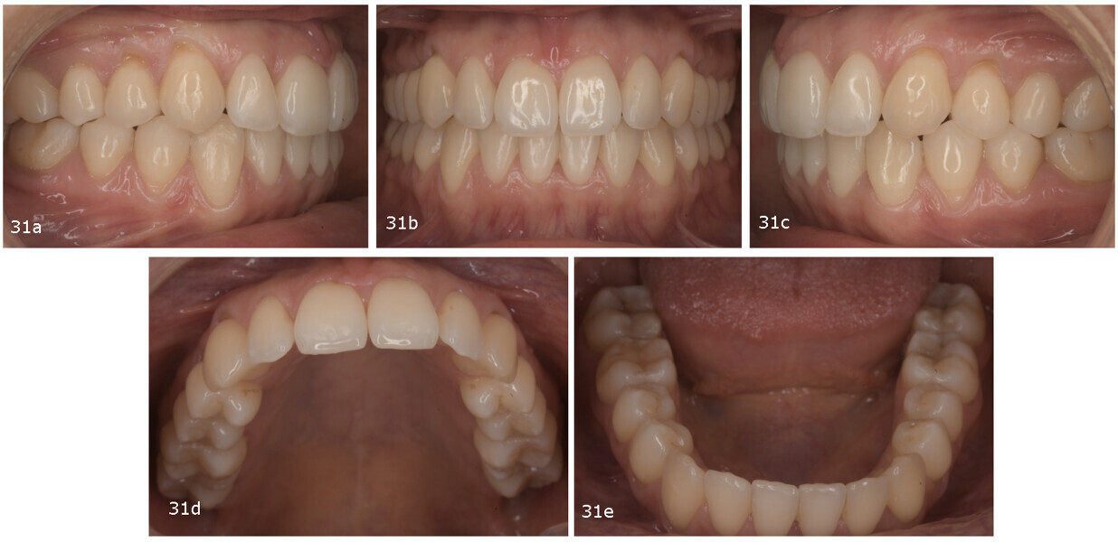 Figs. 31a–e: Post-treatment intra-oral photographs.