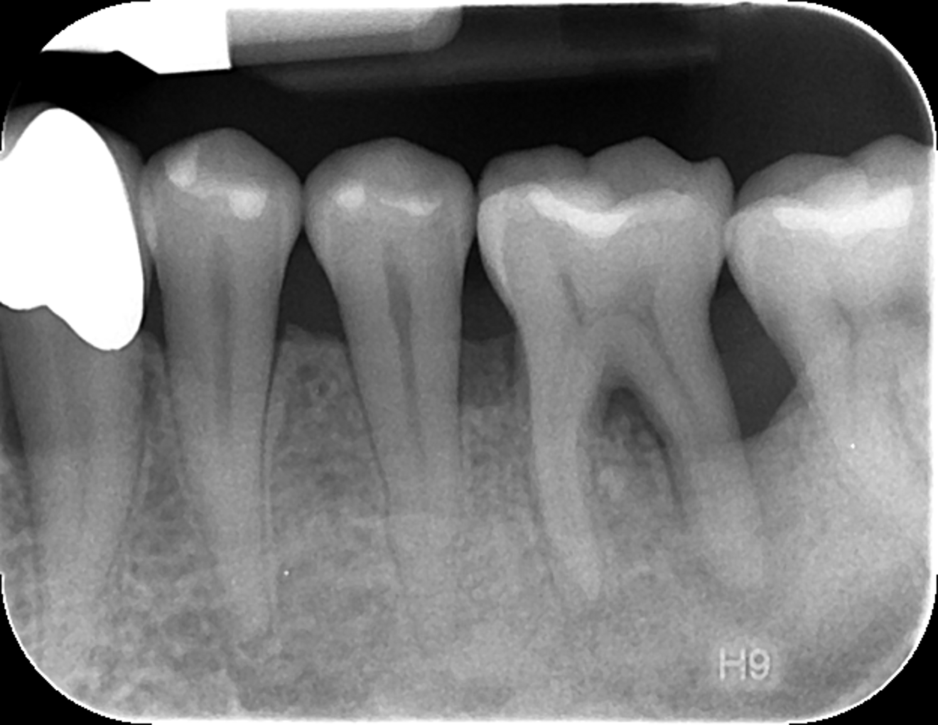 Fig. 6: Periapical radiograph of tooth #36 after treatment.