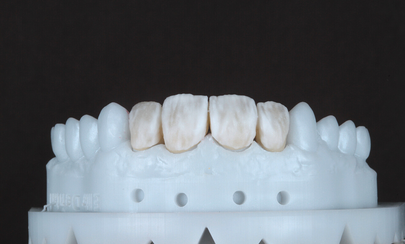 Fig. 9 : Restaurations sur le modèle après la dernière stratification avec les céramiques Luster pour parfaire la morphologie.