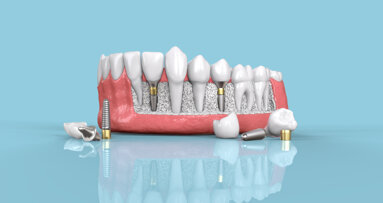 Researchers review dental implant placement using flapless versus flapped technique