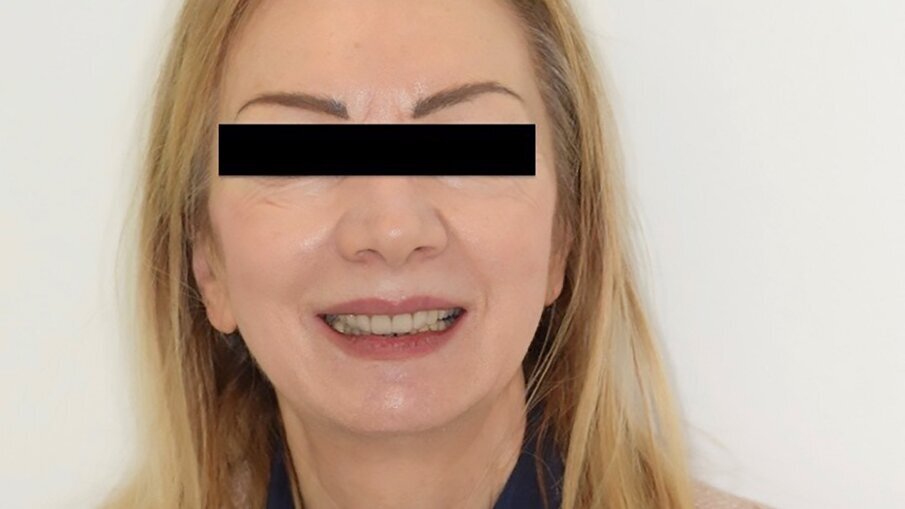Fig. 13: Perioral aspect of the veneers during smiling.