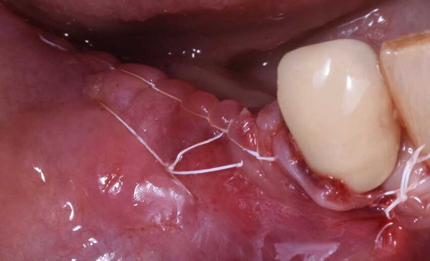 Fig. 8 - Suture.