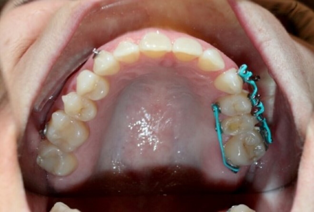 Fig. 12: After six months of space closure.