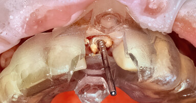 Guided applications for partial extraction therapy