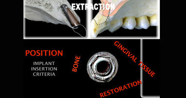 Free webinar: Esthetic protocols for rehabilitation with implants