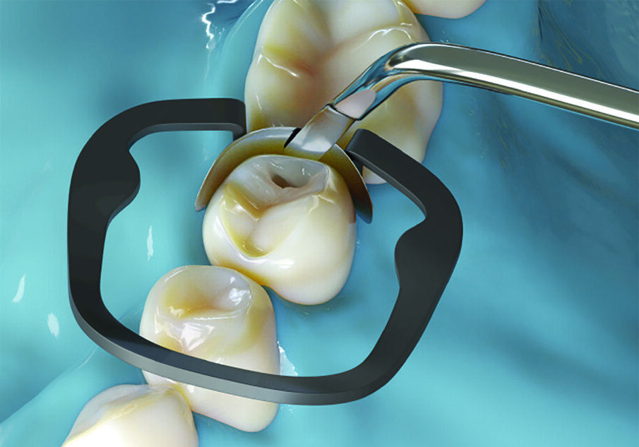 The resilient working ends rebound back to its original shape after use and are excellent for creating fine anatomical detail with delicate, artistic strokes during aesthetic restorations.