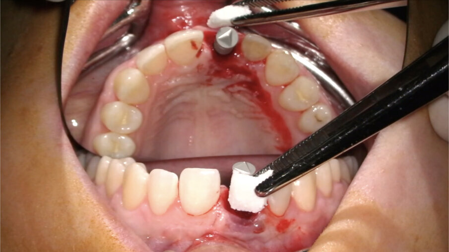Fig. 22_Posizionamento della matrice in collagene.