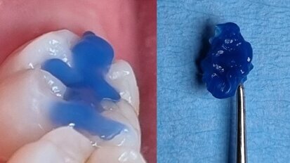 The stamp technique: Quick and effective restoration with glass hybrids