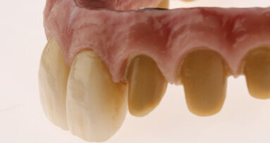 Full-arch rehabilitation with lithium disilicate secondary crowns luted on to the primary framework