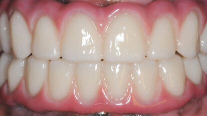 Edentulous arch restored with BruxZir Full-Arch Implant Prosthesis