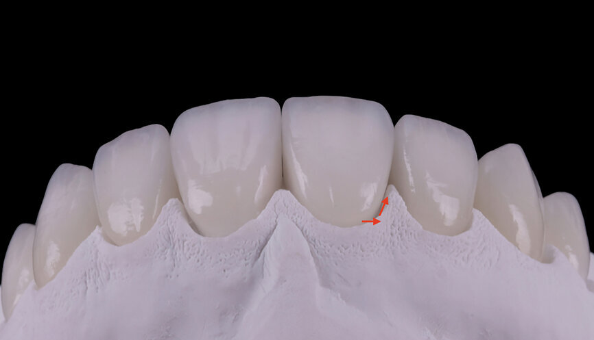 67: Horizontal emergence angle
and emergence profile of the veneers.