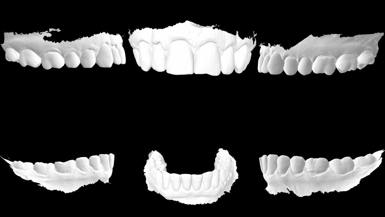 Fig. 6 : Fichier STL du scan intra-oral.