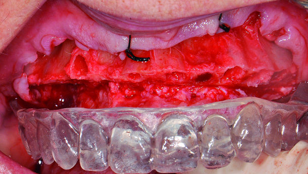 An indirect method for provisionalisation: The team approach in a complete mouth hybrid reconstruction