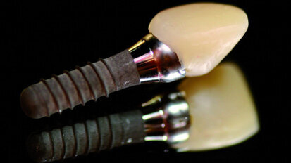 Utilizing the Tempcap abutment with CAD/CAM: Combination of Tempcap, in-office CAD/CAM and e.max allows for final restoration