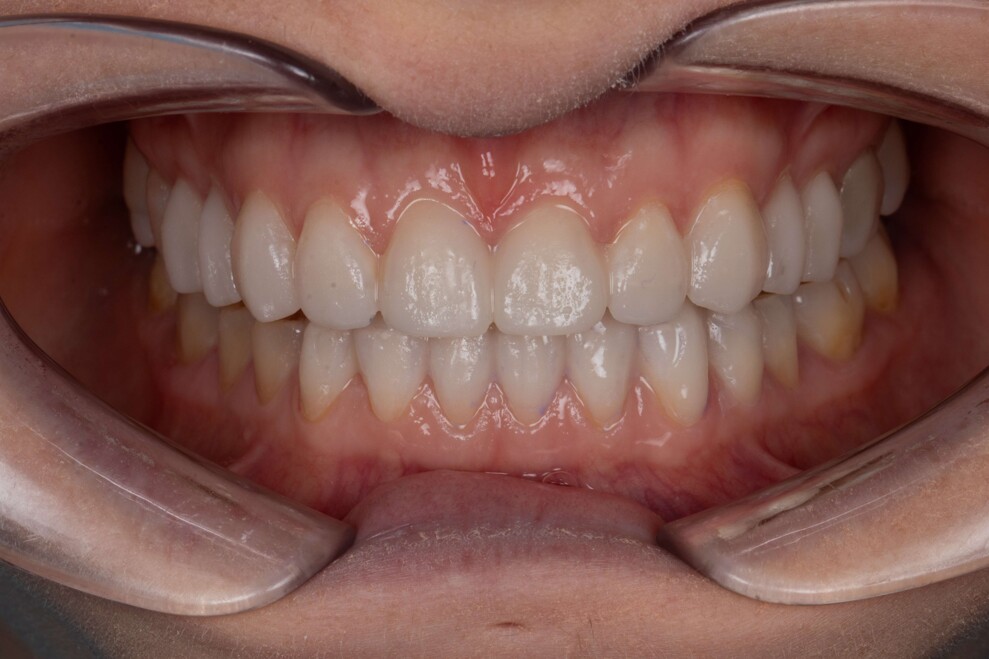 Fig. 4: Mock-up intraorale utilizzato nell’ambito del flusso di lavoro guidato dal volto per valutare la lunghezza prevista dei denti anteriori.