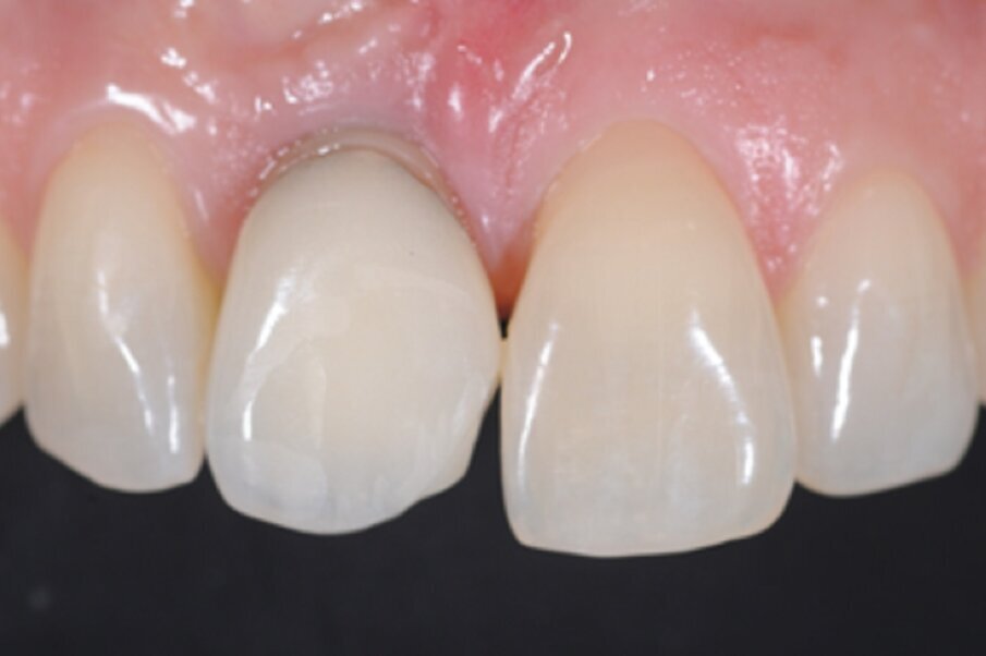 Fig. 14a: Failed anterior crown.