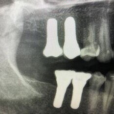 Case Report - Bilateral rehabilitation with zirconia implants