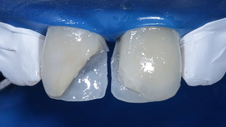 Fig 8 Palatal shell