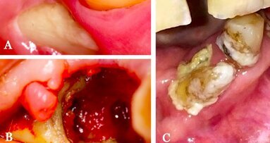 Estrategias para prevenir la osteonecrosis maxilar inducida por medicamentos