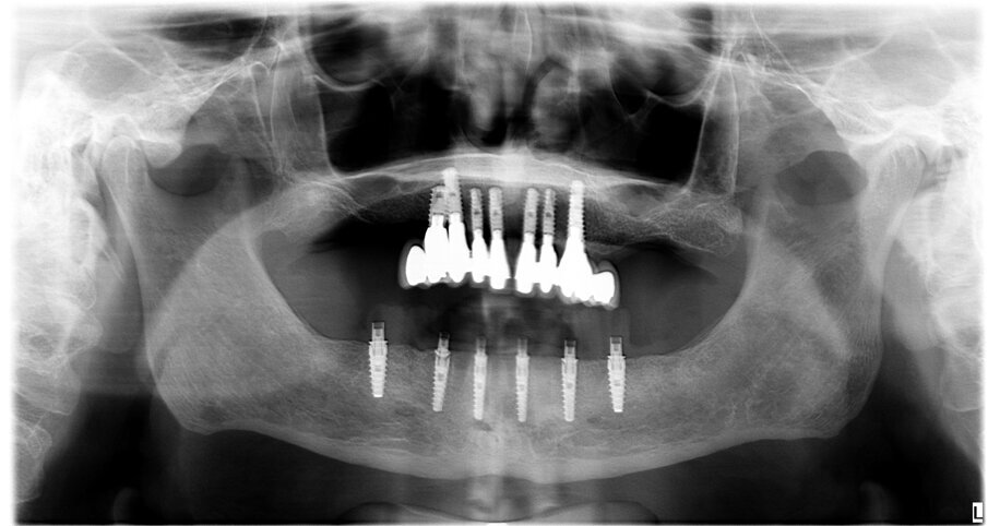 Fig. 23 - Rx con carico immediato.