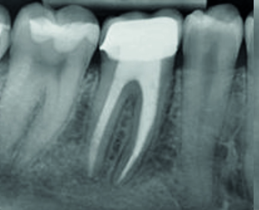 Fig. 9: Control radiograph after one year