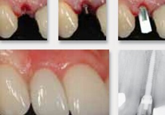 ANEW Implants