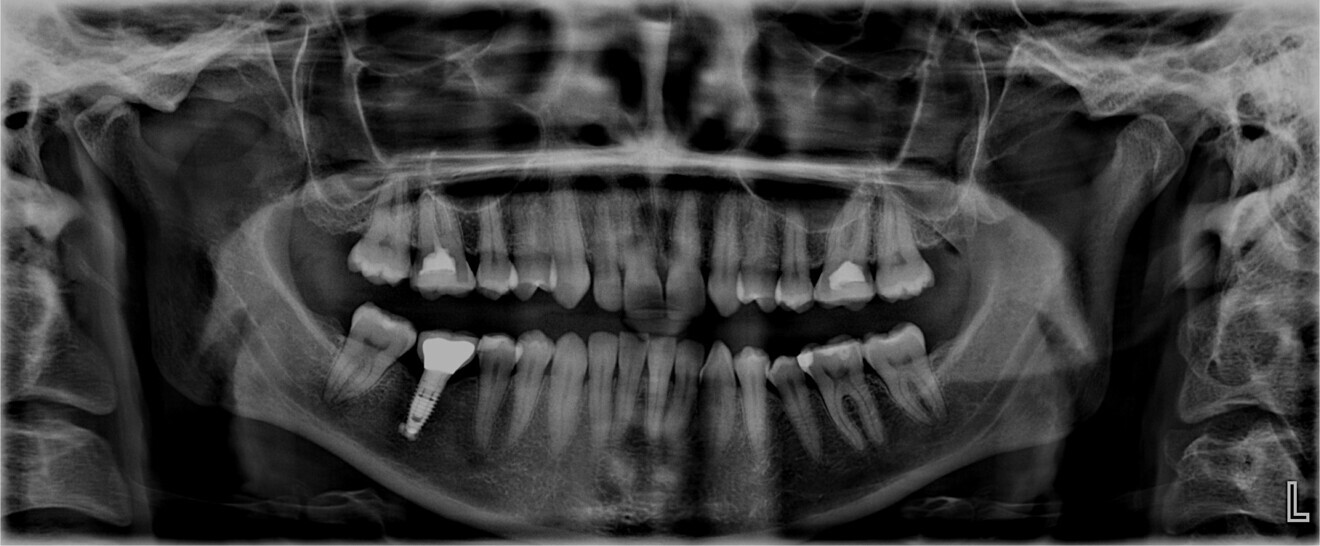 Fig. 3: Pretreatment panoramic radiograph.