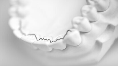 CAD/CAM-fabricated lingual retainers made of nitinol