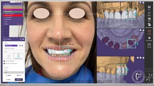 Slika 3: Dizajniranje prototipa u exocad Smile Creator-u