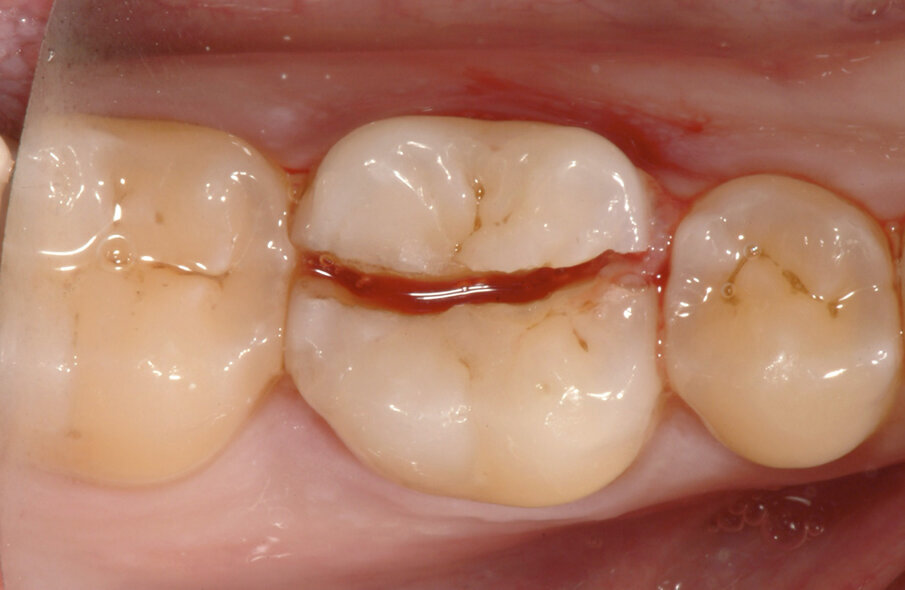 Fig. 1: A vertical fracture of tooth #46. On probing, a distal narrow isolated pocket measuring more than 15 mm in depth was detected.