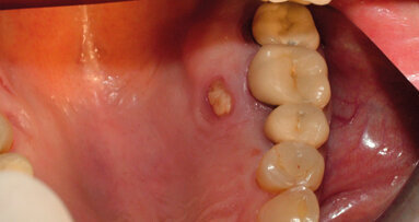 MRONJ del palato: case report