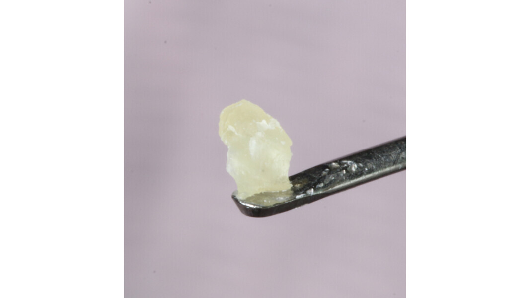 Fig. 18: Stone removed.