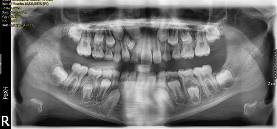 Fig. 2_Ortopantomografia delle arcate dentarie che evidenzia i rapporti con gli elementi dentari adiacenti.