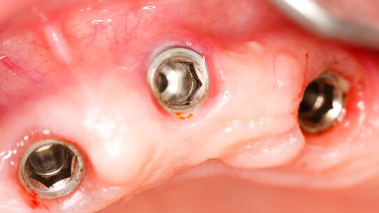Saudi dentists receive U.S. patent for novel soft tissue augmentation tech