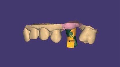 Il workflow digitale REX PiezoImplant nelle creste sottili